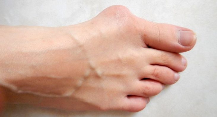 chirurgie de l'hallux valgus Rennes-Bretagne - photo Lamiot creative commons
